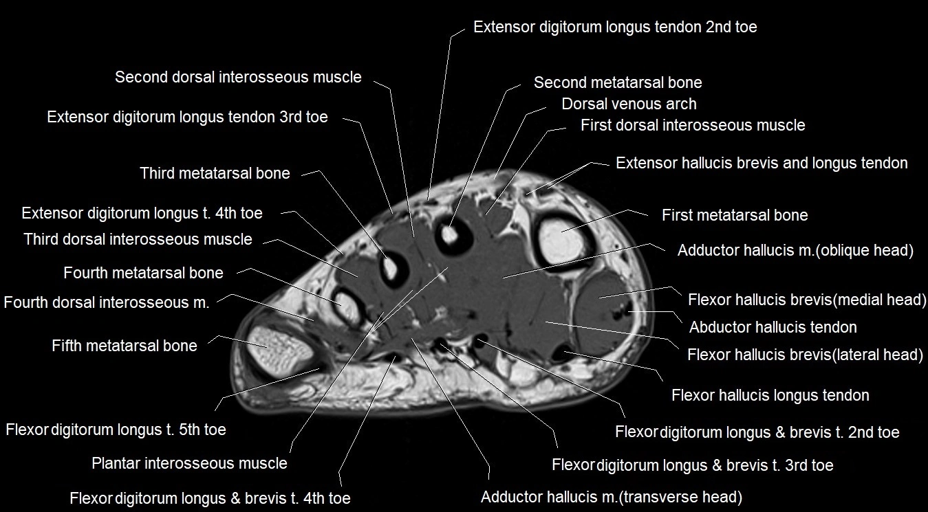 MRI 3T foot axial cross sectional anatomy image 22.webp